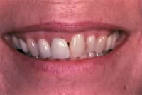 Crown Lengthening,Charles F. Orth, DDS, PA