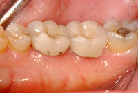 crown lengthening after