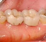 crown lengthening after