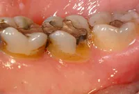 crown lengthening after