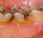 crown lengthening after