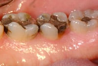 crown lengthening before