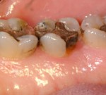 crown lengthening before