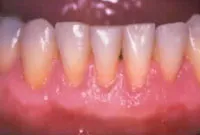 gum grafting after