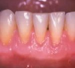 gum grafting after