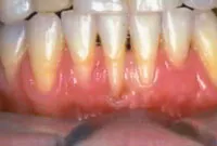 gum grafting before