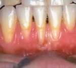 gum grafting before