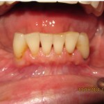 teeth in a day before