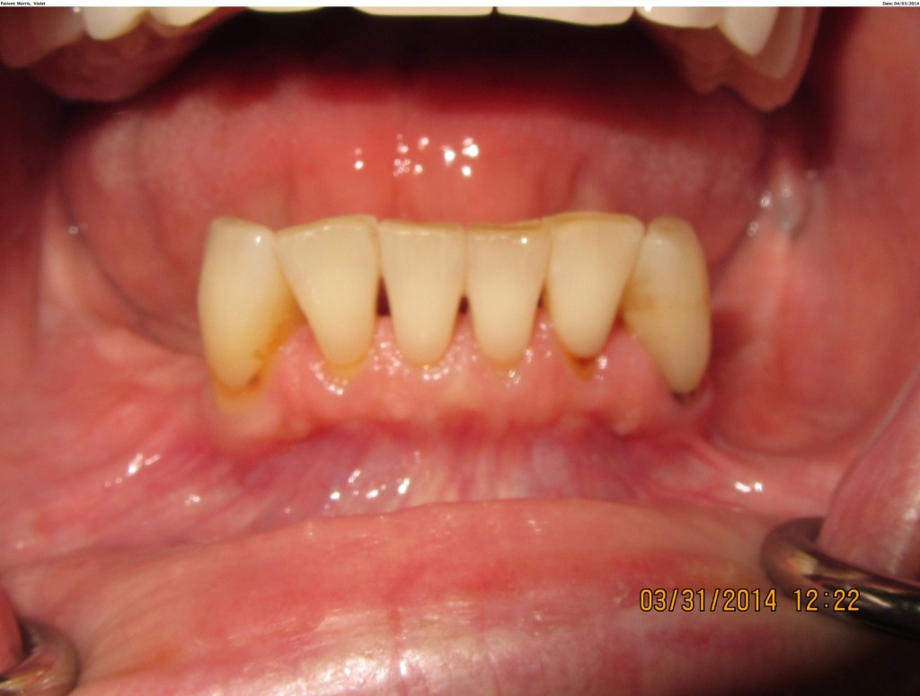 teeth in a day before