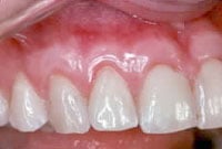 Crown Lengthening,Charles F. Orth, DDS, PA