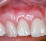 Crown Lengthening,Charles F. Orth, DDS, PA