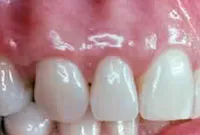 Crown Lengthening,Charles F. Orth, DDS, PA