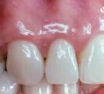 Crown Lengthening,Charles F. Orth, DDS, PA