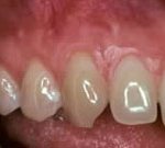 Crown Lengthening,Charles F. Orth, DDS, PA