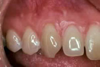 Crown Lengthening,Charles F. Orth, DDS, PA