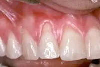 Bone augmentation,Charles F. Orth, DDS, PA
