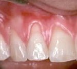 Bone augmentation,Charles F. Orth, DDS, PA
