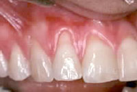 Bone augmentation,Charles F. Orth, DDS, PA