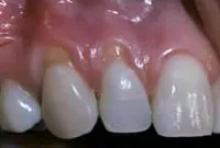 Crown Lengthening,Charles F. Orth, DDS, PA