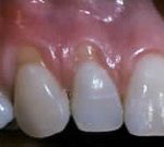Crown Lengthening,Charles F. Orth, DDS, PA