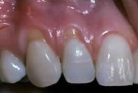 Crown Lengthening,Charles F. Orth, DDS, PA