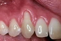 Crown Lengthening,Charles F. Orth, DDS, PA