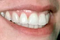 Crown Lengthening,Charles F. Orth, DDS, PA